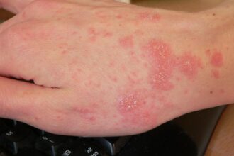 all-you-need-to-know-about:-scabies