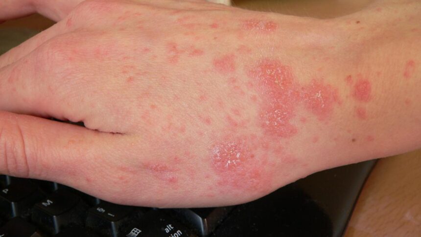 all-you-need-to-know-about:-scabies