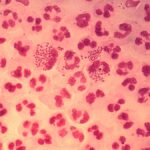 all-you-need-to-know-about:-gonorrhoea