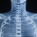 large-genetic-study-finds-overlaps-between-schizophrenia,-bone-health