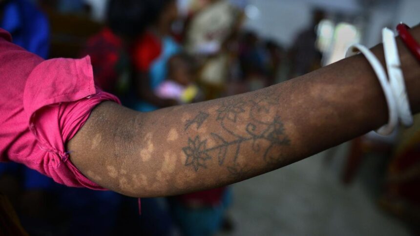 kala-azar-in-india-treading-the-last-mile-towards-elimination | GIBN kala-azar-in-india:-treading-the-last-mile-towards-elimination