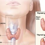 do-you-think-you-have-a-malfunctioning-thyroid?-doctors-say,-consult-before-testing