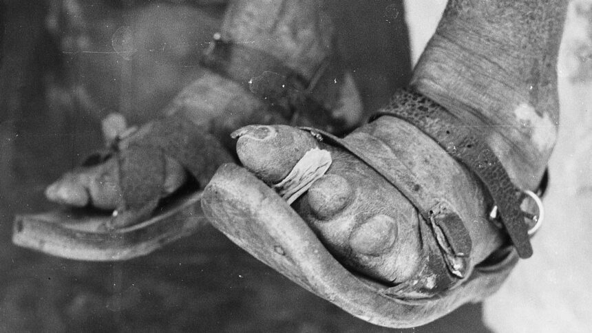 the-story-of-dapsone:-from-dye-to-drug