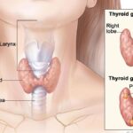 thyroid-disorders:-prevention-and-early-detection