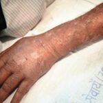 chronic-hives-demands-long-term-care,-not-endless-trigger-searches:-experts