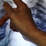 shorter-all-oral-tb-regimens-cost-effective-in-india:-icmr-study