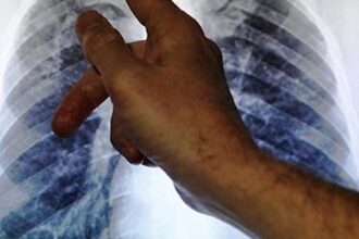 shorter-all-oral-tb-regimens-cost-effective-in-india:-icmr-study