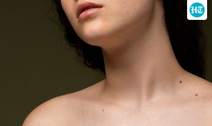 do-you-know-what-disorder-skin-tags-can-indicate-explains-the-neurosurgeon-with-over-33-years-of-experience | GIBN do-you-know-what-disorder-“skin-tags”-can-indicate?-explains-the-neurosurgeon-with-over-33-years-of-experience