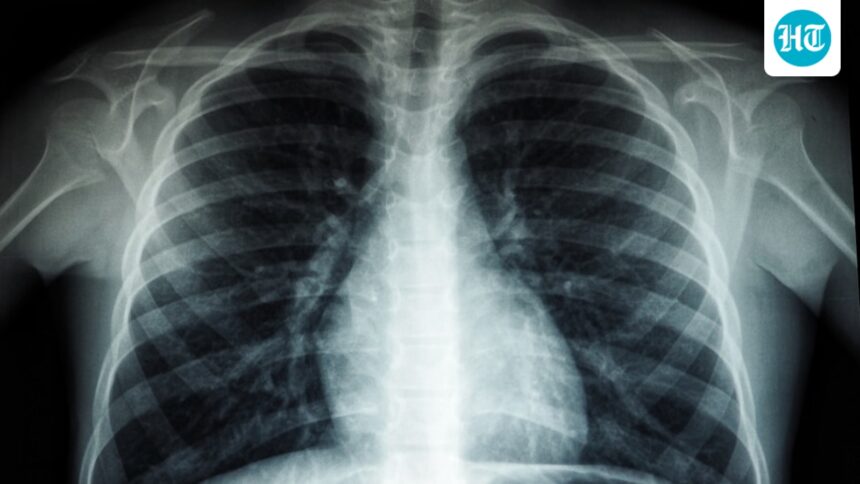 more-than-6100-new-tb-cases-in-maharashtra-in-35-days-11091-villages-were-classified-as-high-risk | GIBN more-than-6,100-new-tb-cases-in-maharashtra-in-35-days;-11,091-villages-were-classified-as-high-risk