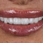 3d-hollywood-smile-technology:-how-is-a-hollywood-smile-made?