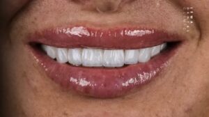 3d-hollywood-smile-technology:-how-is-a-hollywood-smile-made?