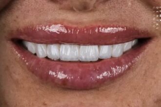 3d-hollywood-smile-technology:-how-is-a-hollywood-smile-made?