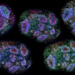 supreme-court-lens-on-stem-cell-therapy-for-autism