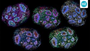 supreme-court-lens-on-stem-cell-therapy-for-autism