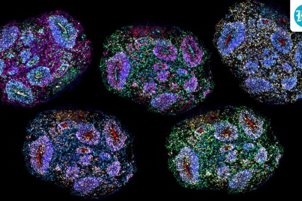 supreme-court-lens-on-stem-cell-therapy-for-autism