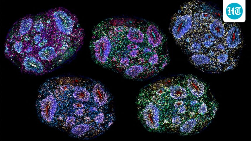 supreme-court-lens-on-stem-cell-therapy-for-autism