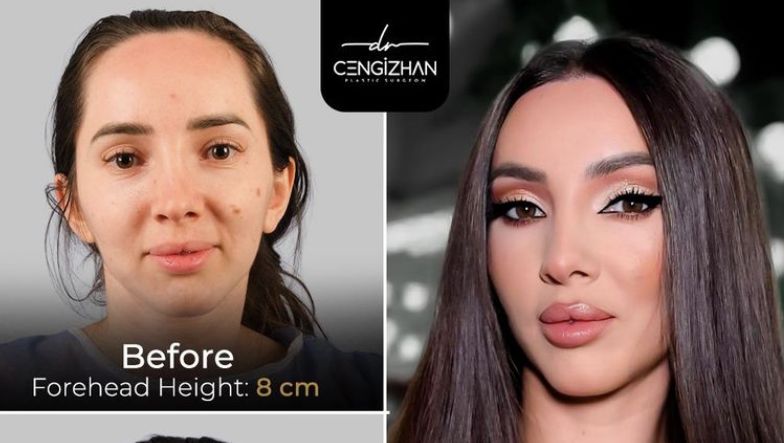 forehead-reduction-surgery-turkey:-creating-a-lower-hairline-for-more-balanced-facial-proportions